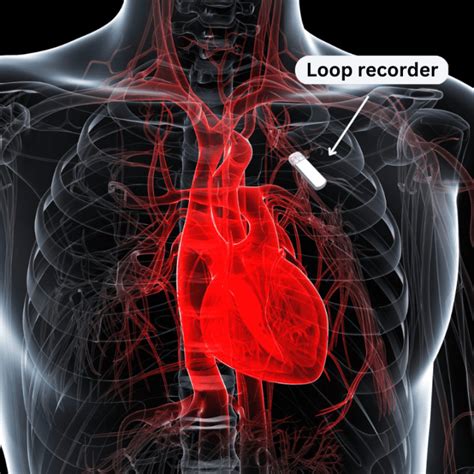 implantable loop recorder icd 10